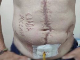 Ukrainian serviceman returned from Russian captivity with "Glory to Russia" inscription on his body.