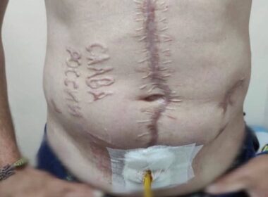 Ukrainian serviceman returned from Russian captivity with "Glory to Russia" inscription on his body.