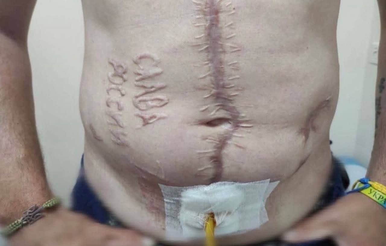 Ukrainian serviceman returned from Russian captivity with "Glory to Russia" inscription on his body.
